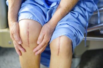Dr. Jason Pirozzolo shares top tips for avoiding surgery recovery mistakes